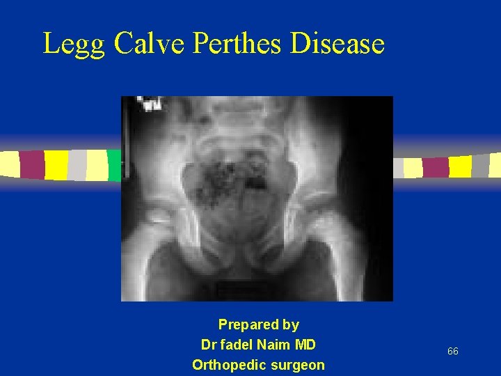 Legg Calve Perthes Disease Prepared by Dr fadel Naim MD Orthopedic surgeon 66 