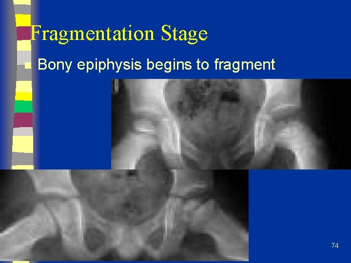 Fragmentation Stage n Bony epiphysis begins to fragment 74 
