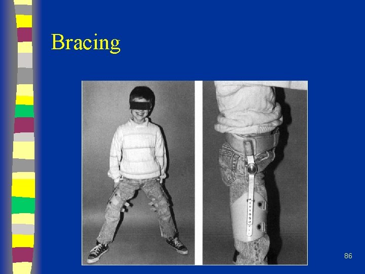 Bracing 86 