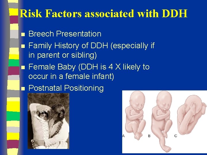 Risk Factors associated with DDH n n Breech Presentation Family History of DDH (especially