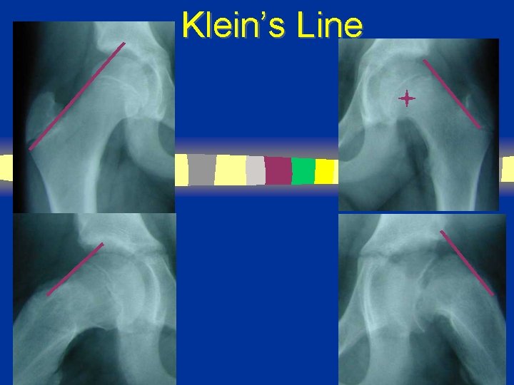 Klein’s Line 