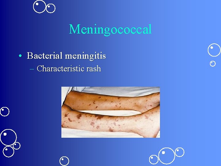 Meningococcal • Bacterial meningitis – Characteristic rash 