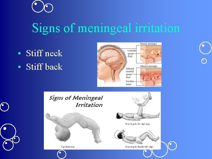 Signs of meningeal irritation • Stiff neck • Stiff back 