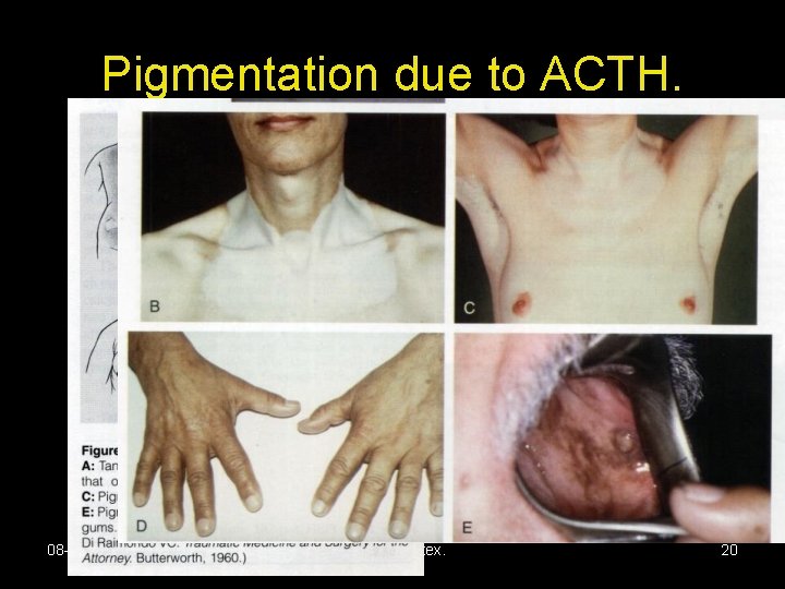 Pigmentation due to ACTH. 08 -01 -14 Adrenal Cortex. 20 