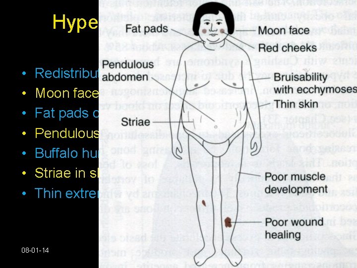 Hyper Adrenalism- Cushings Disease. • • Redistribution of fat. Moon face. Fat pads of