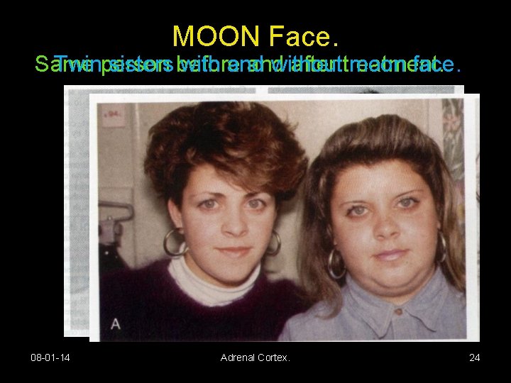 MOON Face. Same Twinperson sisters before with and without after treatment. moon face. 08