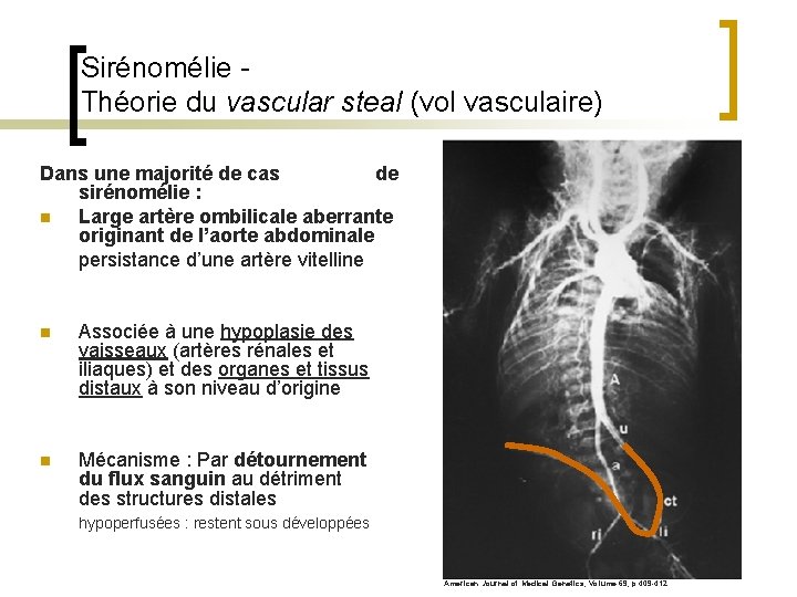 Sirénomélie Théorie du vascular steal (vol vasculaire) Dans une majorité de cas de sirénomélie