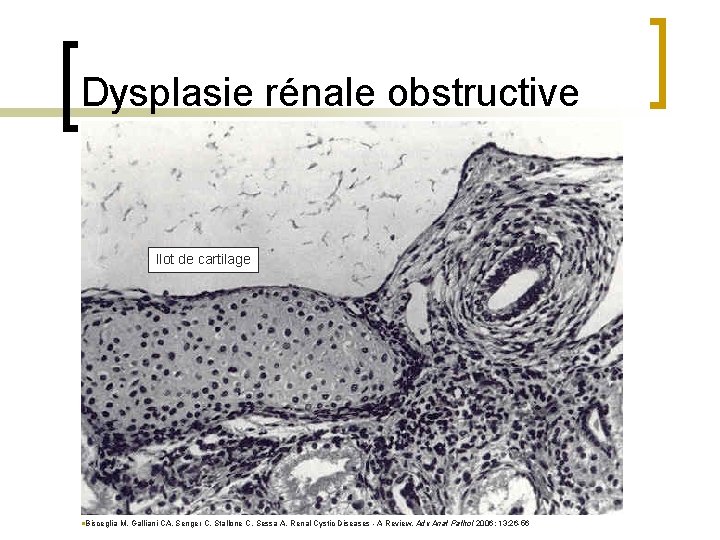 Dysplasie rénale obstructive Ilot de cartilage n. Bisceglia M, Galliani CA, Senger C, Stallone