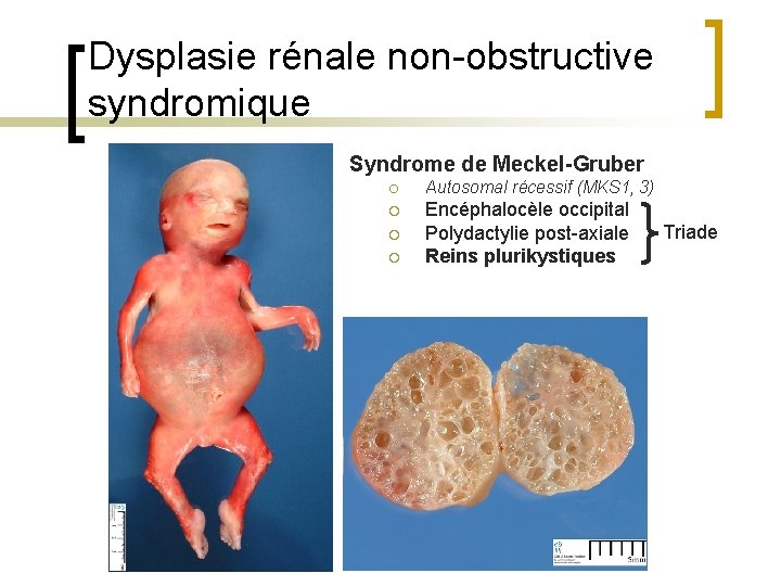 Dysplasie rénale non-obstructive syndromique Syndrome de Meckel-Gruber ¡ Autosomal récessif (MKS 1, 3) ¡
