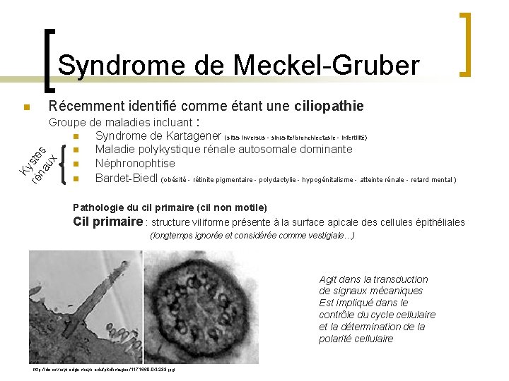 Syndrome de Meckel-Gruber Récemment identifié comme étant une ciliopathie Groupe de maladies incluant :
