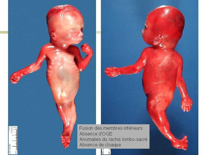 Fusion des membres inférieurs Absence d’OGE Anomalies du rachis lombo-sacré Absence de cloaque 