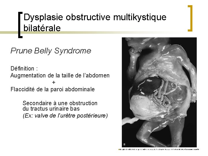 Dysplasie obstructive multikystique bilatérale Prune Belly Syndrome Définition : Augmentation de la taille de