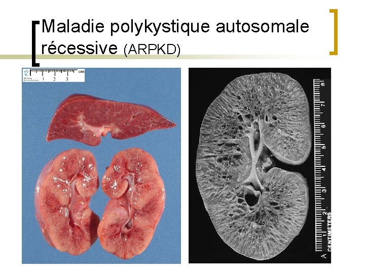 Maladie polykystique autosomale récessive (ARPKD) 