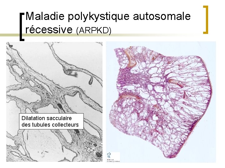 Maladie polykystique autosomale récessive (ARPKD) Dilatation sacculaire des tubules collecteurs 