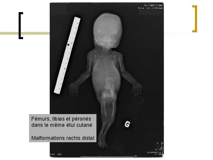 Fémurs, tibias et péronés dans le même étui cutané Malformations rachis distal 