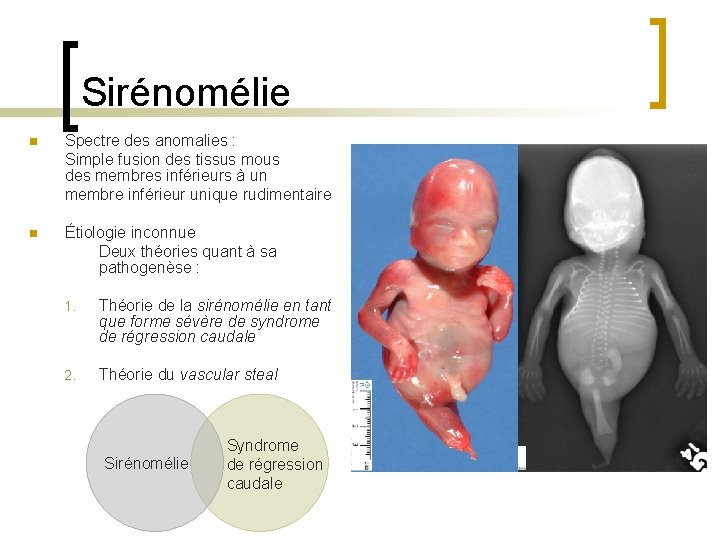 Sirénomélie n Spectre des anomalies : Simple fusion des tissus mous des membres inférieurs