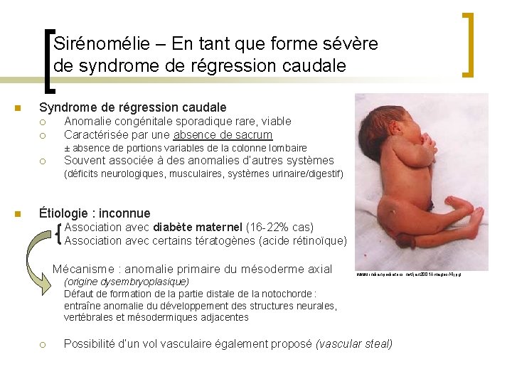 Sirénomélie – En tant que forme sévère de syndrome de régression caudale n Syndrome