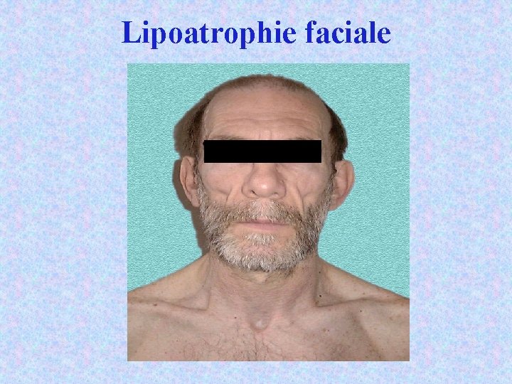 Lipoatrophie faciale 