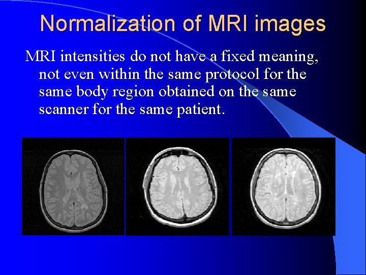 Normalization of MRI images MRI intensities do not have a fixed meaning, not even