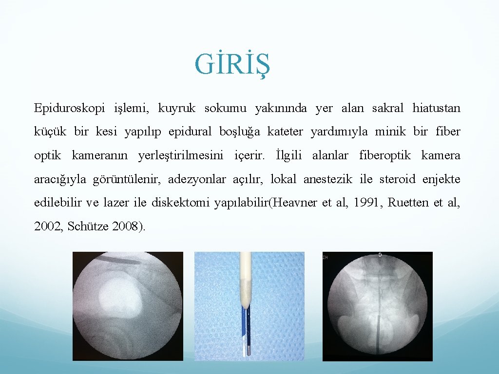 GİRİŞ Epiduroskopi işlemi, kuyruk sokumu yakınında yer alan sakral hiatustan küçük bir kesi yapılıp