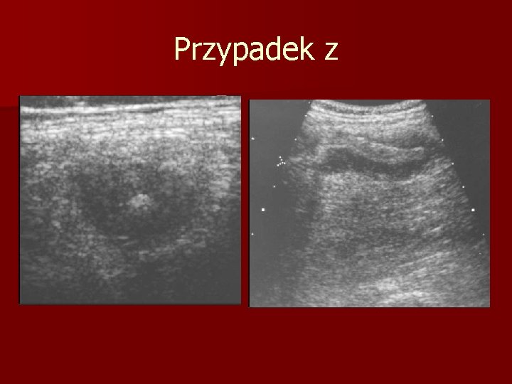 Przypadek z 