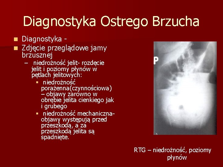 Diagnostyka Ostrego Brzucha n n Diagnostyka Zdjęcie przeglądowe jamy brzusznej – niedrożność jelit- rozdęcie