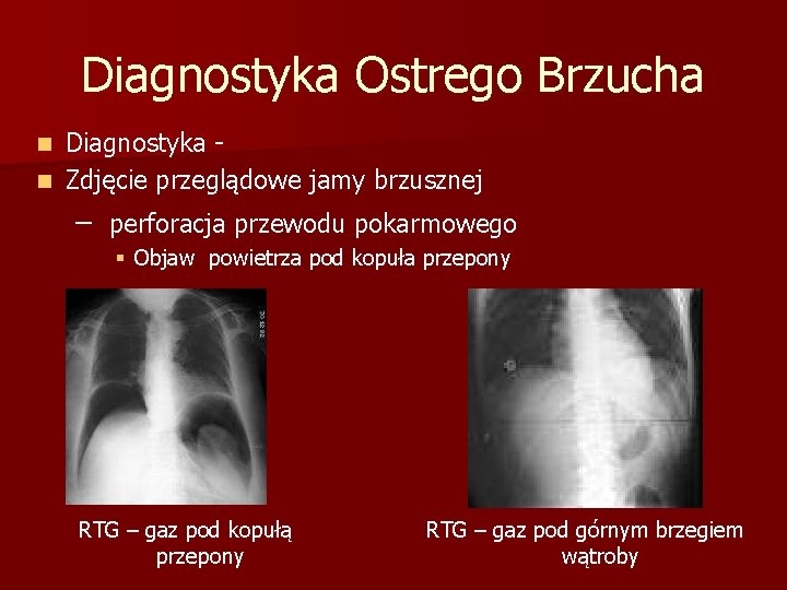 Diagnostyka Ostrego Brzucha Diagnostyka n Zdjęcie przeglądowe jamy brzusznej n – perforacja przewodu pokarmowego