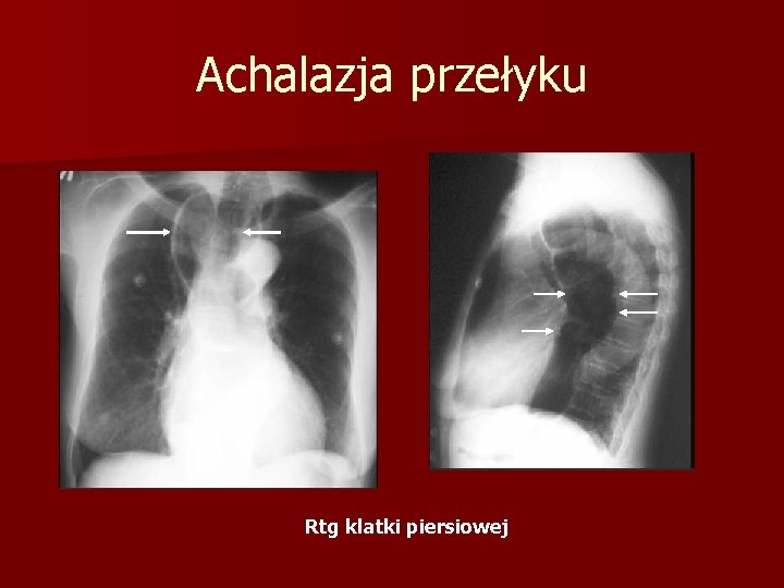 Achalazja przełyku Rtg klatki piersiowej 