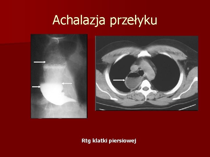 Achalazja przełyku Rtg klatki piersiowej 