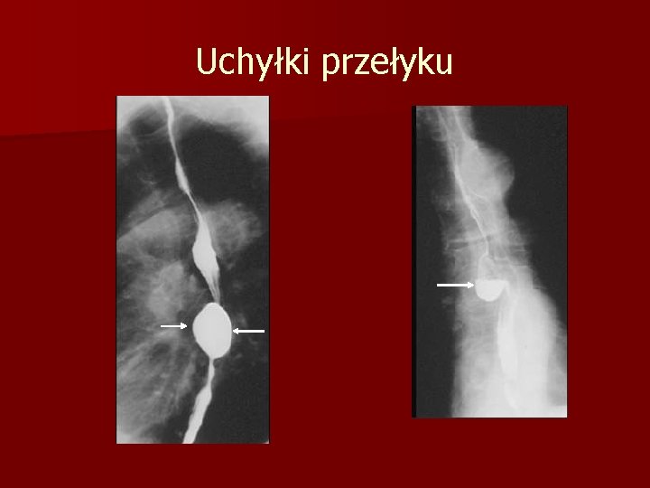 Uchyłki przełyku 