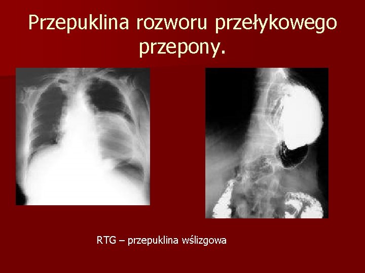 Przepuklina rozworu przełykowego przepony. RTG – przepuklina wślizgowa 