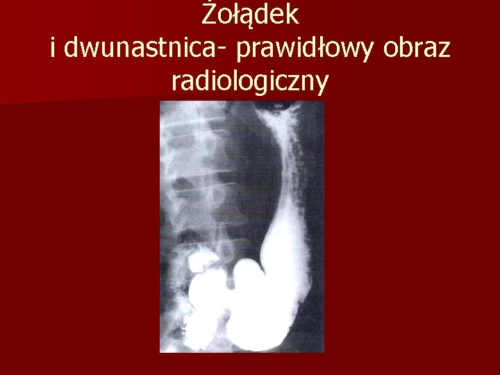 Żołądek i dwunastnica- prawidłowy obraz radiologiczny 