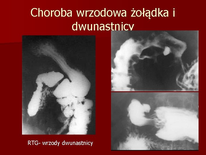 Choroba wrzodowa żołądka i dwunastnicy RTG- wrzody dwunastnicy 