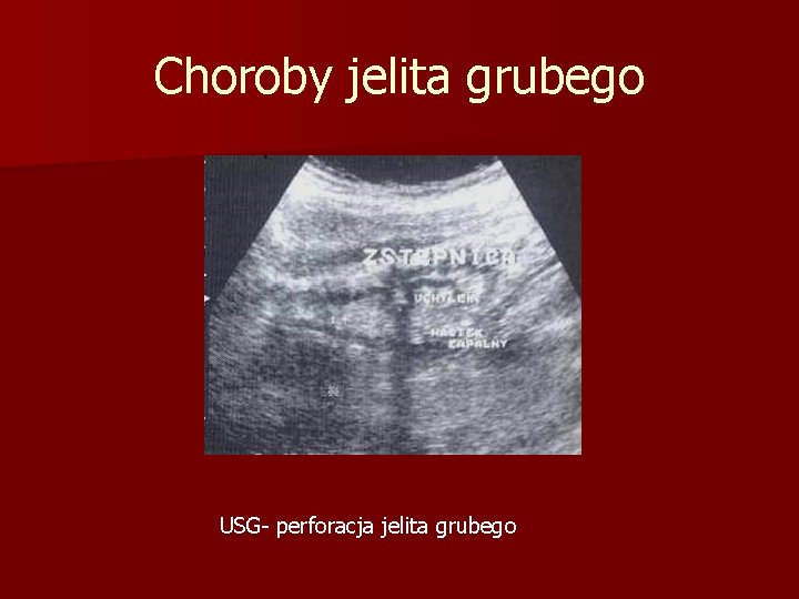 Choroby jelita grubego USG- perforacja jelita grubego 