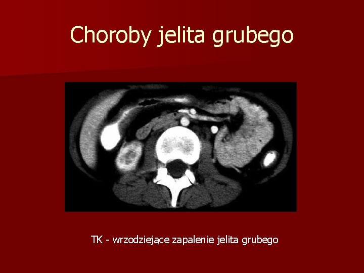 Choroby jelita grubego TK - wrzodziejące zapalenie jelita grubego 