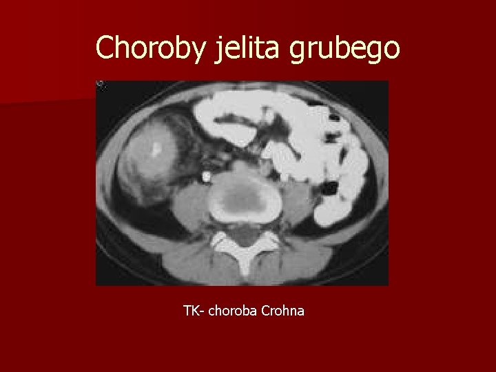 Choroby jelita grubego TK- choroba Crohna 