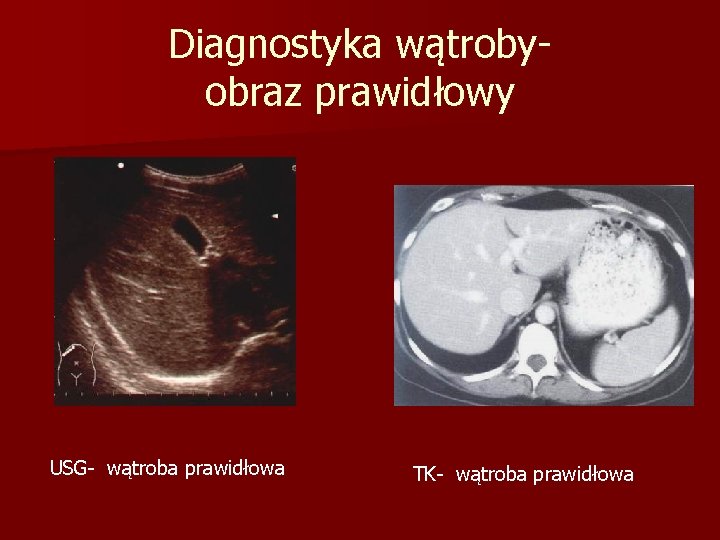 Diagnostyka wątrobyobraz prawidłowy USG- wątroba prawidłowa TK- wątroba prawidłowa 