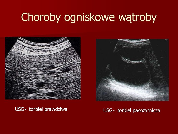 Choroby ogniskowe wątroby USG- torbiel prawdziwa USG- torbiel pasożytnicza 