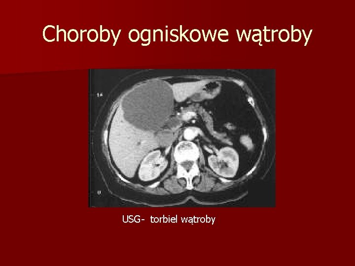 Choroby ogniskowe wątroby USG- torbiel wątroby 