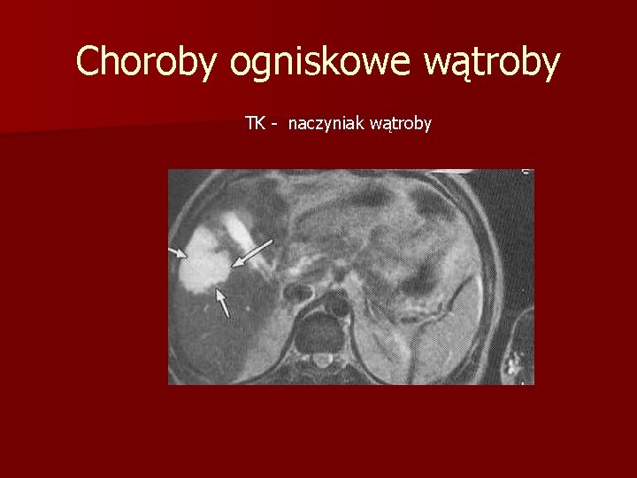 Choroby ogniskowe wątroby TK - naczyniak wątroby 