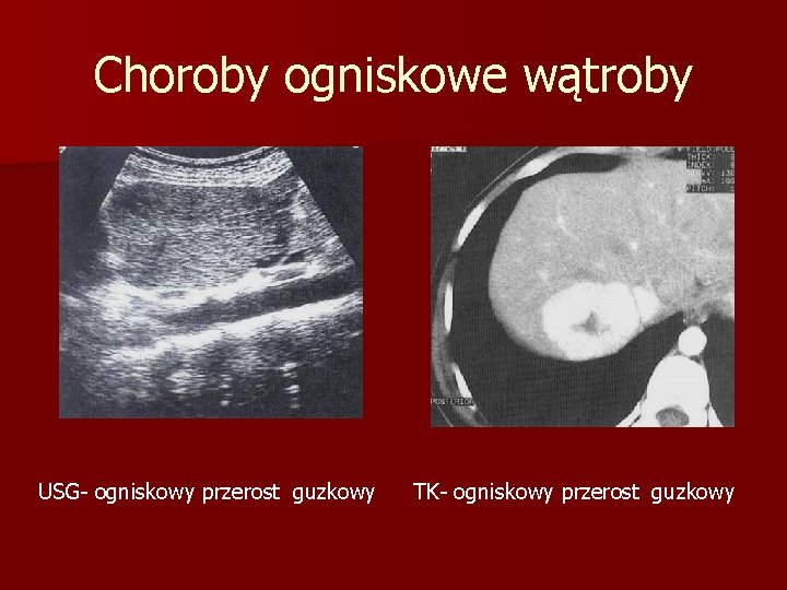 Choroby ogniskowe wątroby USG- ogniskowy przerost guzkowy TK- ogniskowy przerost guzkowy 