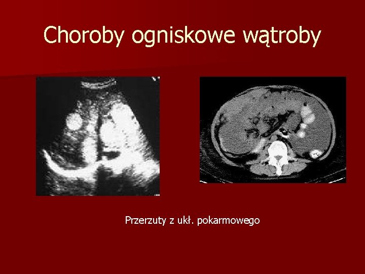 Choroby ogniskowe wątroby Przerzuty z ukł. pokarmowego 