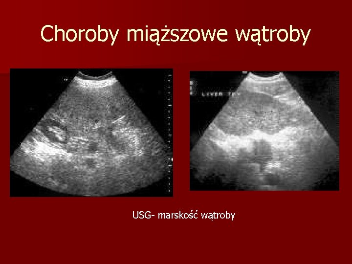 Choroby miąższowe wątroby USG- marskość wątroby 