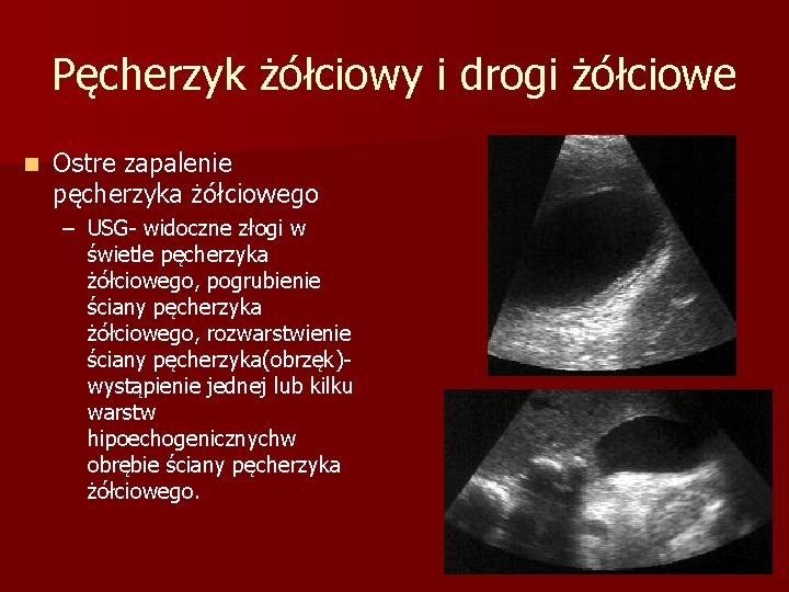 Pęcherzyk żółciowy i drogi żółciowe n Ostre zapalenie pęcherzyka żółciowego – USG- widoczne złogi