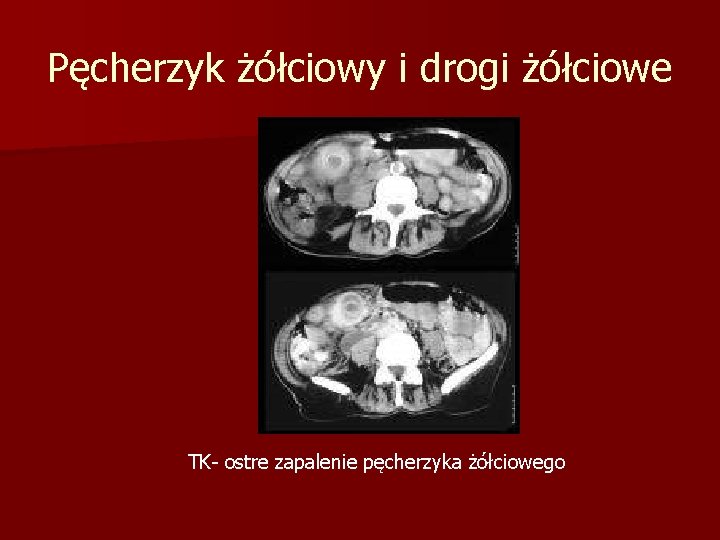 Pęcherzyk żółciowy i drogi żółciowe TK- ostre zapalenie pęcherzyka żółciowego 