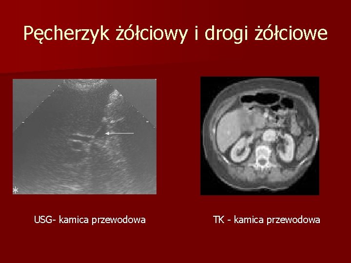 Pęcherzyk żółciowy i drogi żółciowe USG- kamica przewodowa TK - kamica przewodowa 