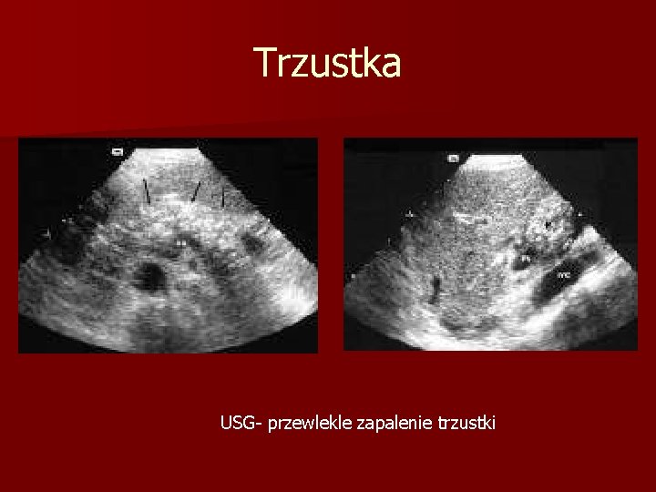 Trzustka USG- przewlekle zapalenie trzustki 