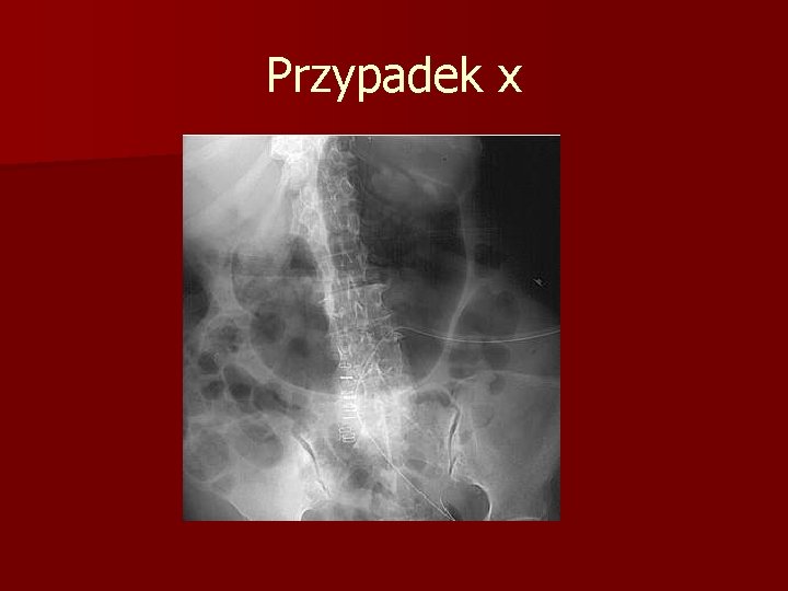 Przypadek x 