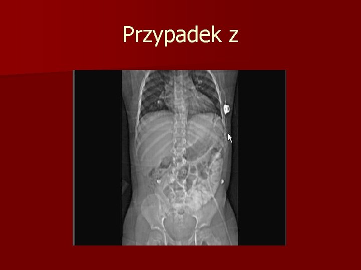 Przypadek z 