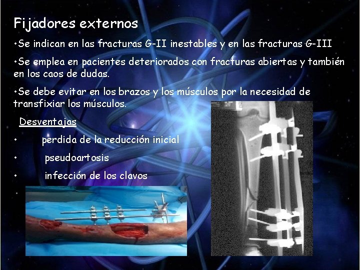 Fijadores externos • Se indican en las fracturas G-II inestables y en las fracturas Fijadores externos • Se indican en las fracturas G-II inestables y en las fracturas